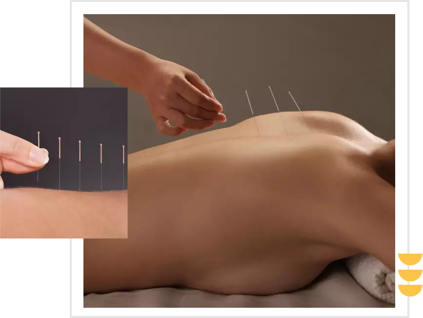 A person is getting their back acupuncture